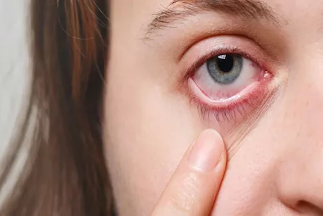 إصابة قرنية العين بحروق الشمس.. طبيبة توضح مخاطر التهاب القرنية الضوئي