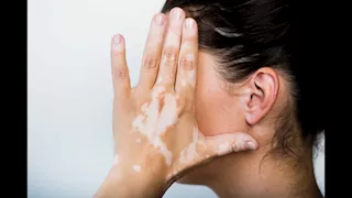 ما أسباب البهاق وكيف تتطور أعراضه؟