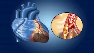  فاكهة تعزز صحة القلب والشرايين.. احرص على تناولها