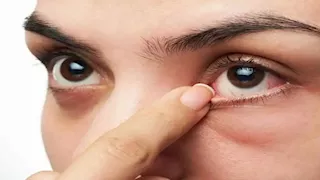  هل يسبب فرك العينين مضاعفات خطيرة؟