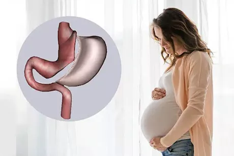 هل يمكن الحمل بعد عملية التكميم؟- طبيب يحسم الجدل "فيديو"