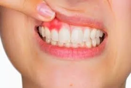نقص هذا الفيتامين أحد أسبابه- دليل شامل عن مرض الإسقربوط