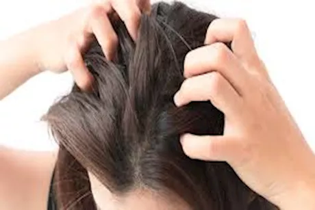 سبب حكة فروة الرأس بعد قص الشعر في الصيف.. إليك بعض النصائح