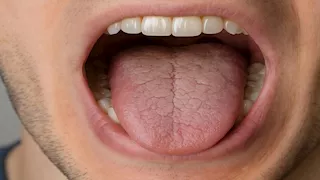 4 أسباب وراء الإصابة بجفاف الفم