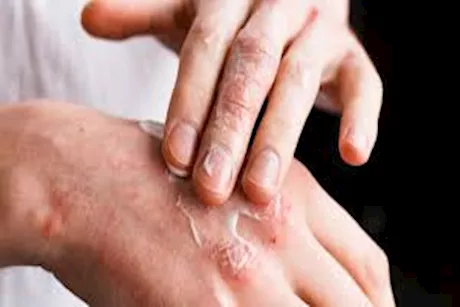 التهاب الجلد في الطقس الحار.. إليك أعراضه الشائعة وطرق العلاج