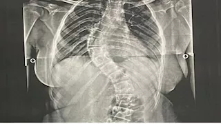 أعادت لها القدرة على الحركة.. مستشفى جامعة الأزهر بأسيوط ينجح في جراحة معقدة لطفلة