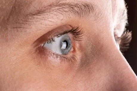 العمى القرنى.. ما هى أعراضه وعوامل الخطر وطرق العلاج منه؟