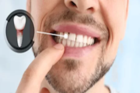 زراعة الأسنان مع فقدان جزء من عظام السن.. هل هذا ممكن؟ 