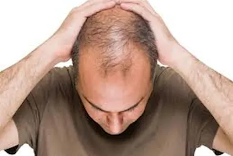 استخدام المينوكسيديل في علاج الصلع الوراثي.. هل يمكن منعه؟