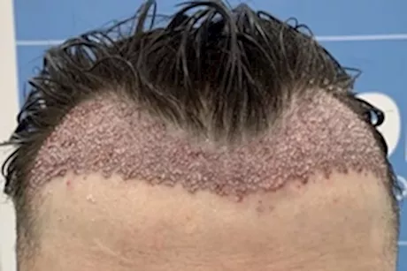 هل إجراء عمليات زراعة الشعر آمنة في فصل الصيف مع ارتفاع درجة الحرارة؟