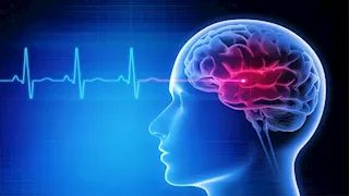 احذر هذه العادات اليومية.. قد تزيد خطر الإصابة بالجلطات الدماغية