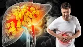 مرض الكبد الدهني.. مخاطر خفية لا ينبغي تجاهلها