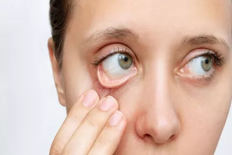 علامات نقص الحديد على الوجه والعين.. احذر ظهورها مبكرًا