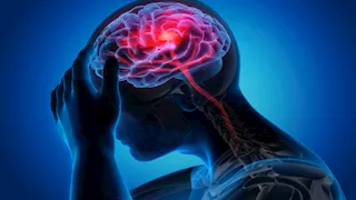 5 علامات قد تكشف الإصابة بالسكتة الدماغية 