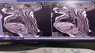 ولدت بـ"القيلة السحائية".. جراحة دقيقة تنقذ رضيعة عمرها 3 أيام في الإسكندرية- صور 