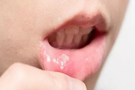 ما هى أسباب ظهور البقع البيضاء على الشفتين عند النساء؟ 