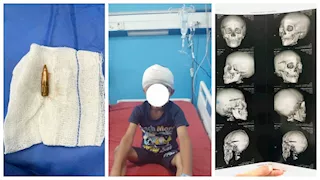 نجاح استخراج رصاصة من مخ طفل عمره 7 سنوات بسوهاج