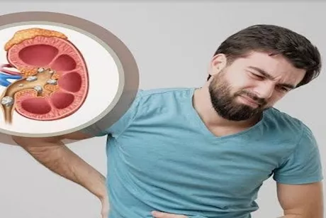 طبيبة هذا المشروب يساعدك في التخلص من حصوات الكلى والتهابات مجرى البول