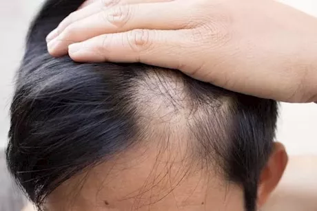 هل زراعة الشعر لعلاج مرض الثعلبة فعال؟- إليكِ الحقيقة