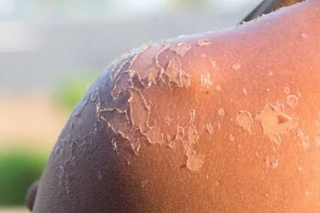 زيت اللافندر لتخفيف حروق الشمس.. إليك كيف يمكنه تهدئة الألم؟