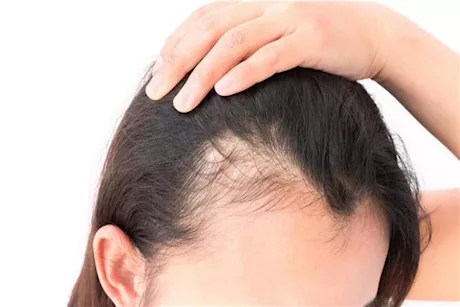 4 أسباب الشعر الدهني عند السيدات.. إليك نصائح لعلاجه في المنزل