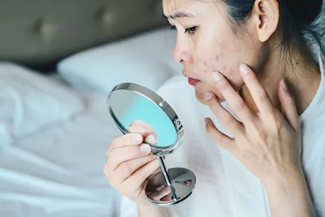 أعراض نقص الفيتامينات- 6 علامات تظهر على الوجه احذرها  