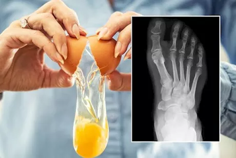  هل البيض مفيد لهشاشة العظام؟- إليك الإجابة "فيديوجرافيك"
