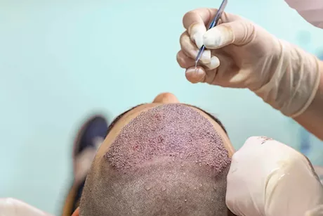 طبيبة تحذر: هذه أسباب فشل عملية زراعة الشعر "فيديو"    