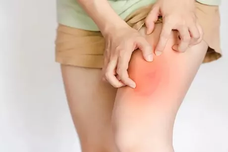 نصائح لمساعدة النساء على التعامل مع طفح الفخذ الداخلي