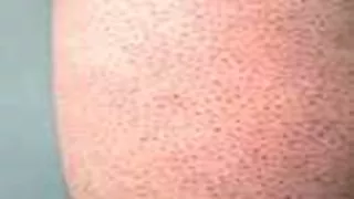 ما سبب ظهور حبوب صغيرة في الذراعين تشبه «جلد الفراولة»؟