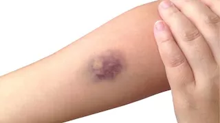 7 أسباب وراء ظهور الكدمات على الجسم.. بينها نقص الفيتامينات
