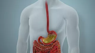 العثور على ذبابة داخل قولون رجل بأمريكا.. كيف دخلت إلى جهازه الهضمي؟