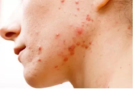 حب الشباب في سن الأربعين- إليك أسبابه وأفضل طرق علاجه   