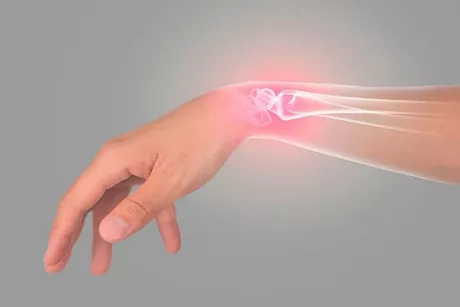 تقنية جراحية جديدة تساعد مرضى كسور الرسغ على التعافي أسرع